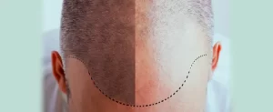FUE hair transplantation in Turkey Antalya