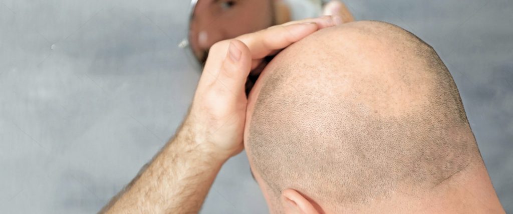 FUE yöntemi ile kalıcı saçlara kavuşun