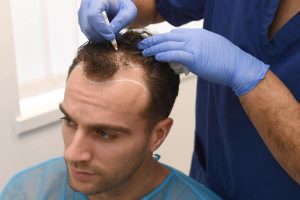 Haartransplantation Türkei Antalya