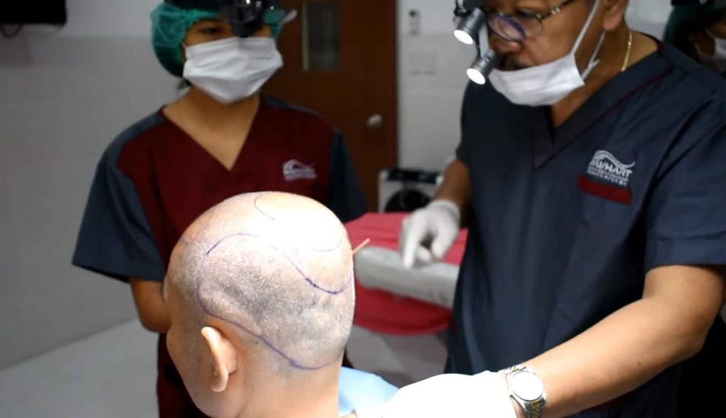 Haarwachstumszeit nach der Haartransplantation Türkei Antalya
