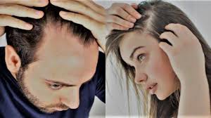 How Long Does Hair Loss Stop