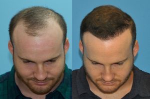 How does success in hair transplantation differ