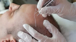 Is Anesthesia Performed in Hair Transplantation