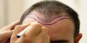 Necessary conditions for hair transplantation