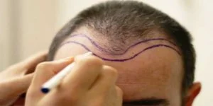 Notwendige Voraussetzungen für eine Haartransplantation