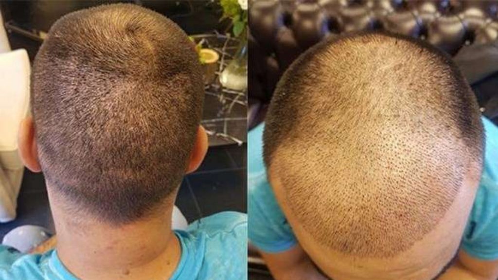 Saç Ekimi Yaptırmak İçin Gerekli Şartlar