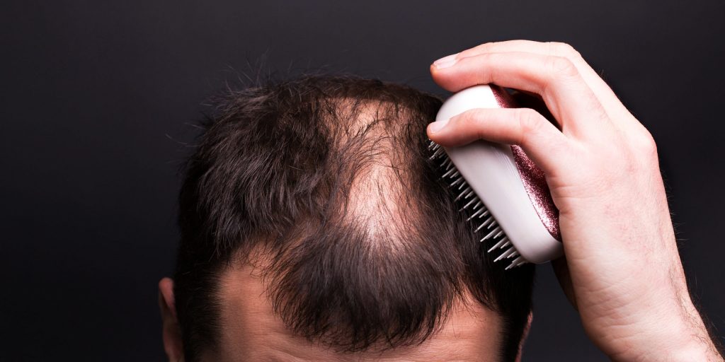 Wie lange dauert es, den Haarausfall zu stoppen?