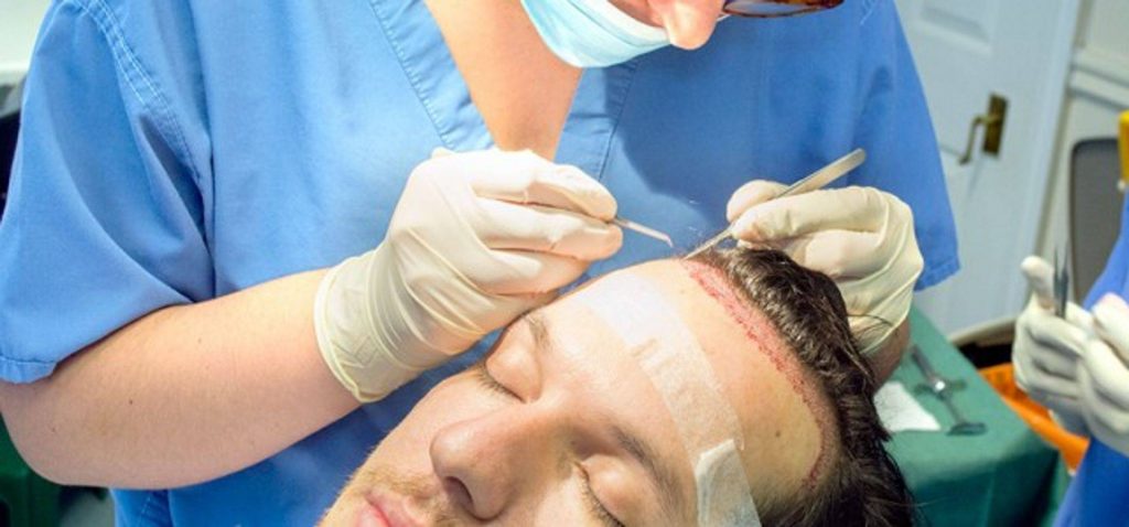 Wird bei der Haartransplantation eine Anästhesie durchgeführt Türkei Antalya